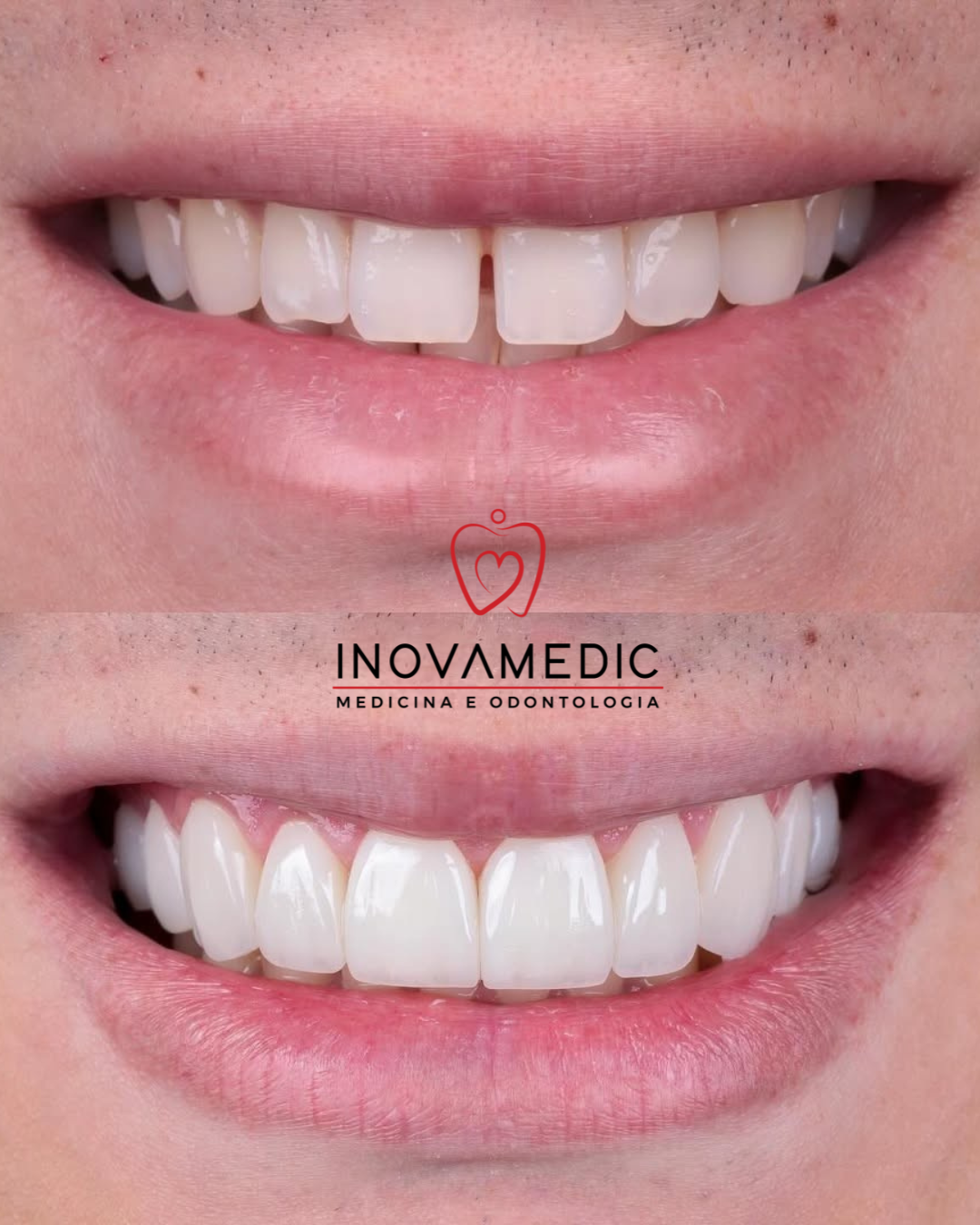 Facetas em resina — antes e depois